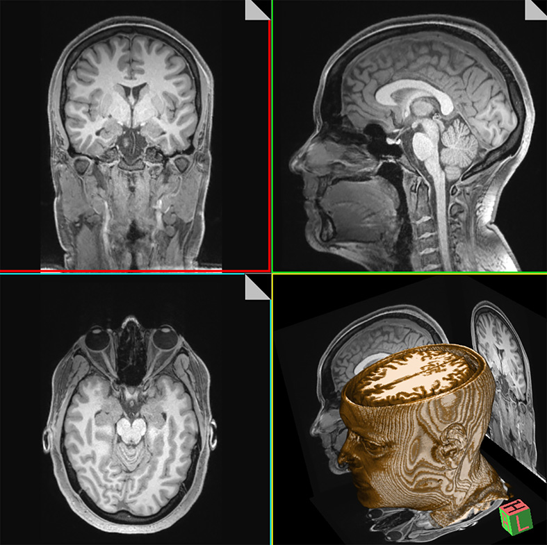 T1-weighted MRI image of a living subject