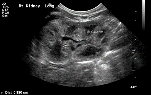 Kidney ultrasound